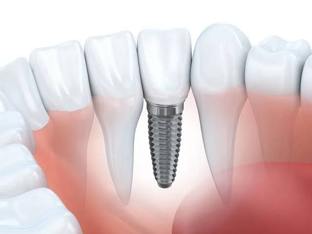 What Are Dental Implants