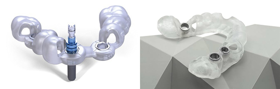guided-implant-surgery