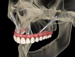 zygoma-dental-implants