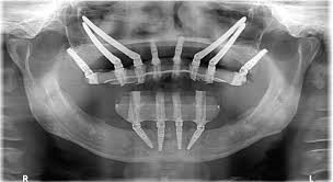 zygoma-implants