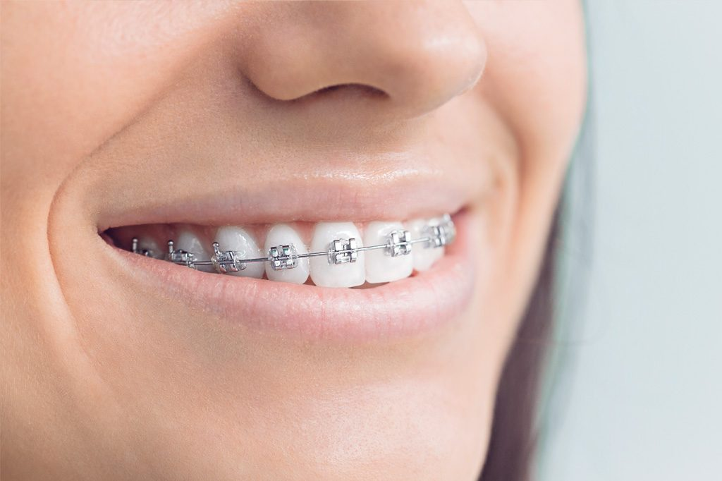 CARE DURING ORTHODONTIC TREATMENT FEBRUARY