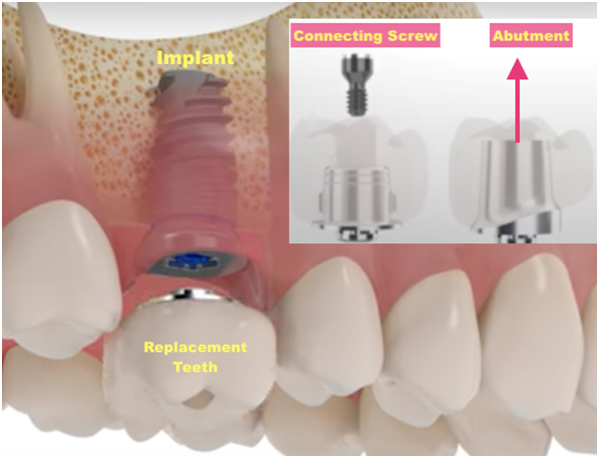 parts of dental implants