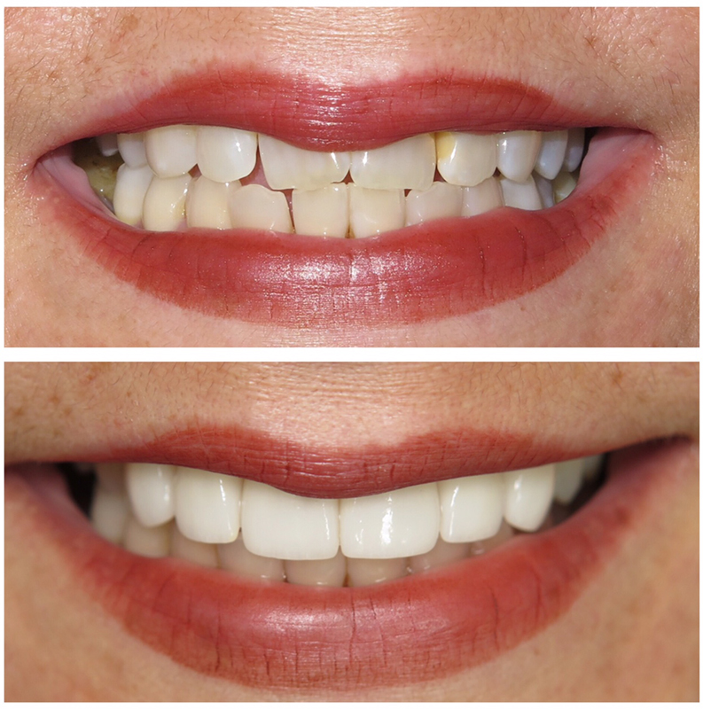 Difference of Cosmetic Dentistry Treatment